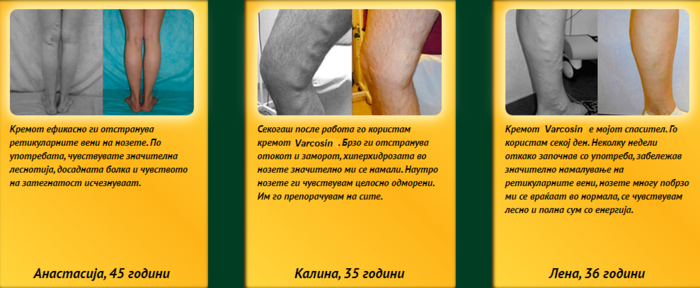 Varcosin критике